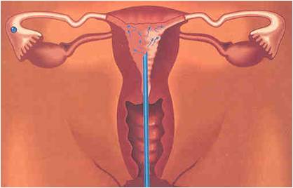 intra uterine